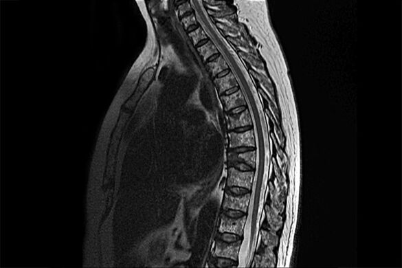A mellkasi osteochondrosis megnyilvánulása az MRI képében