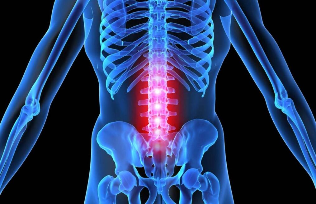 Az ágyéki gerinc osteochondrosis