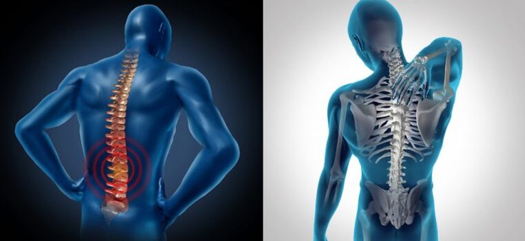 Gyulladás a gerinc osteochondrózisában