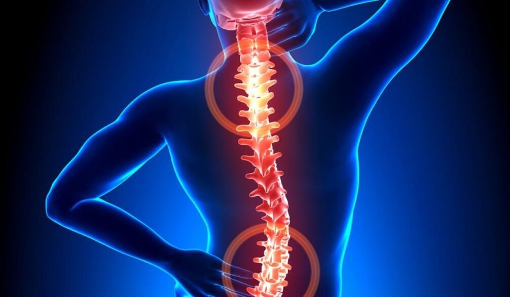 gerinc osteochondrosis