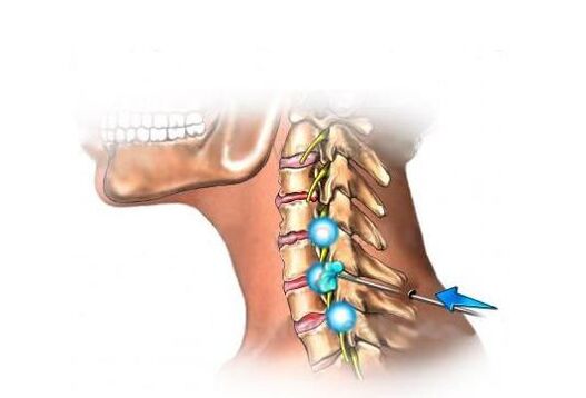 nyaki osteochondrosis kezelése